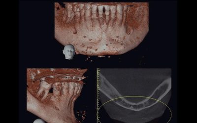 Caso Clínico N° 28 Calsinosis cutánea