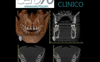 Caso Clínico N° 26 Exostosis mandibular