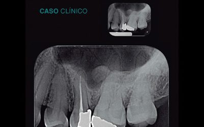 Caso Clínico N° 21 ANTROLITO