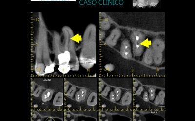 Caso Clínico N° 20 ITSMO