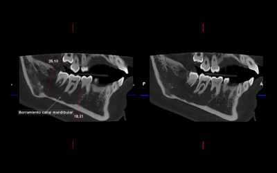 Caso Clínico N° 31 Queratoquiste odontogénico