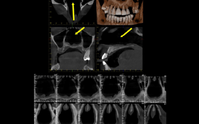 Caso Clínico N° 32 Síndrome de cavidad nasal vacía