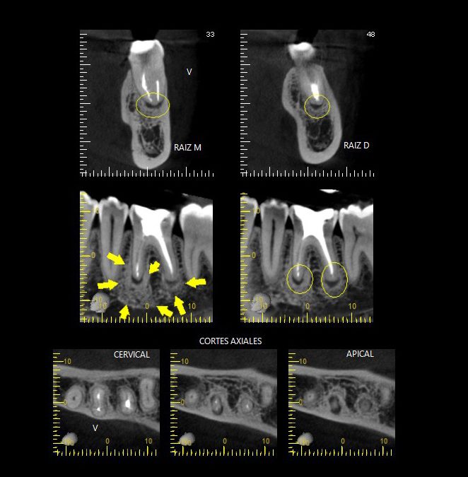 Caso Clínico N° 50 Lesión apical mixta con sospecha de Osteítis Condensante en diente tratado endodónticamente