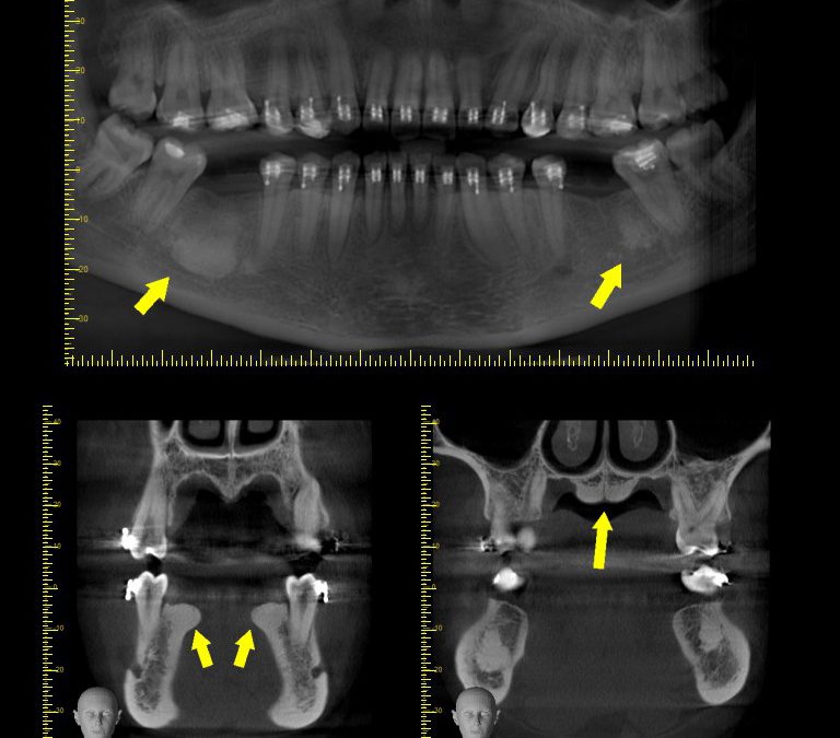 Caso Clínico N° 49 Hallazgos en tomografía Cone Beam