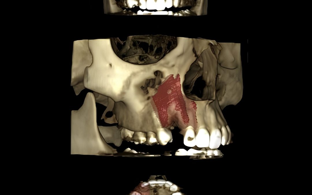 Caso Clínico N° 81 displasia fibrosa