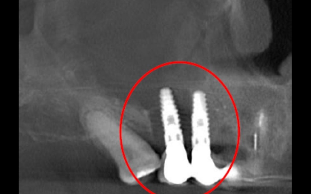 Caso Clínico N° 84 Periimplantitis con compromiso de seno maxilar