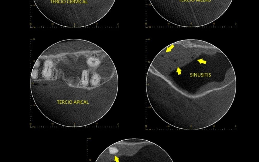 Caso Clínico N° 83 Resto radicular en seno maxilar